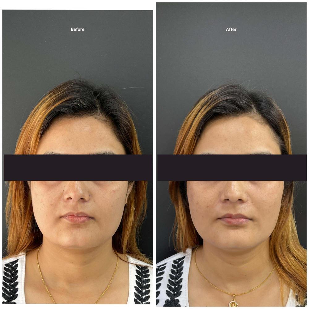 Botox result KOQ10